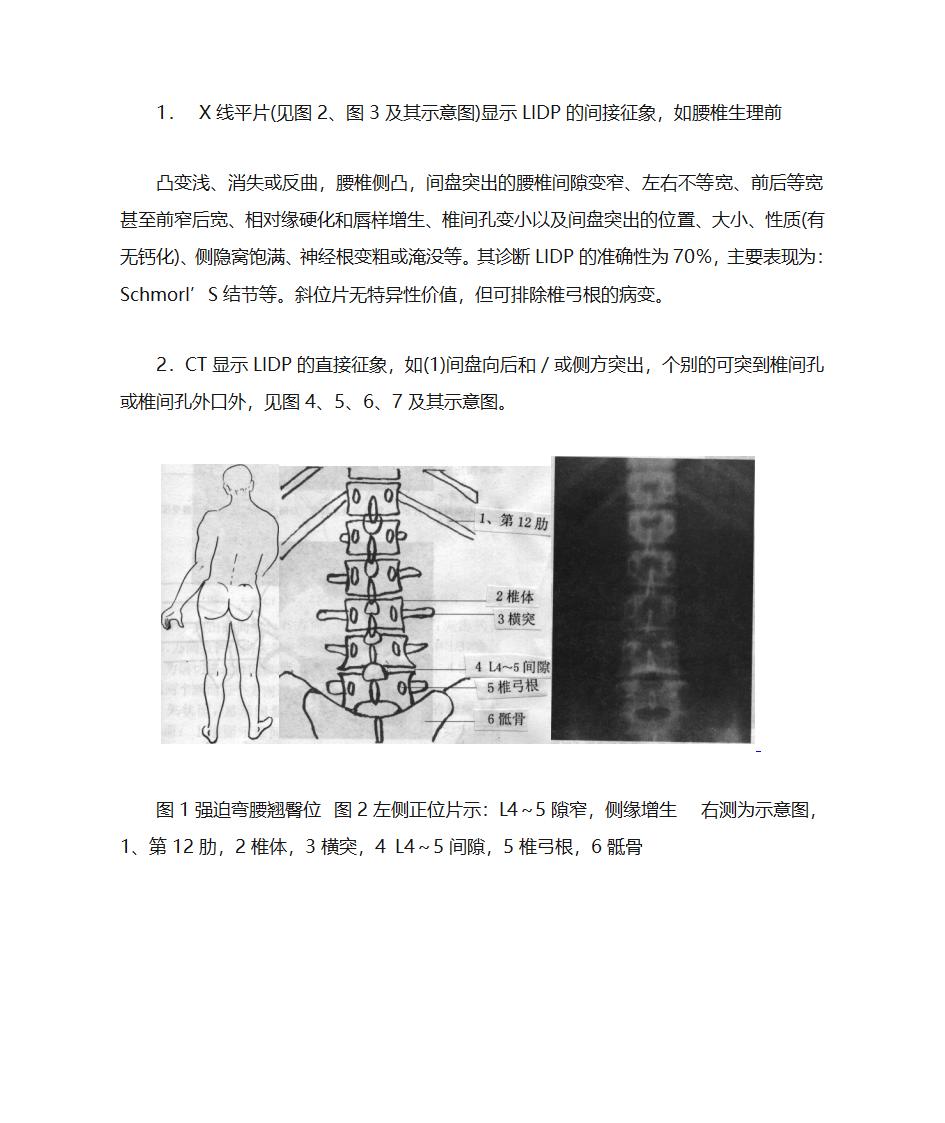 腰间盘突出诊断第4页