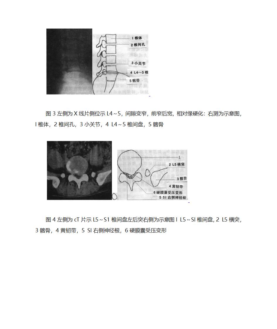 腰间盘突出诊断第5页