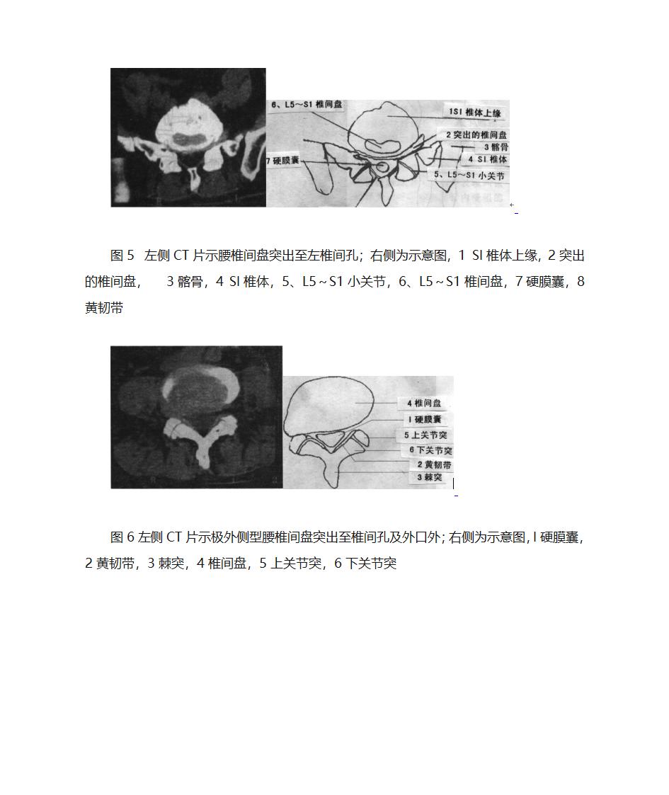 腰间盘突出诊断第6页