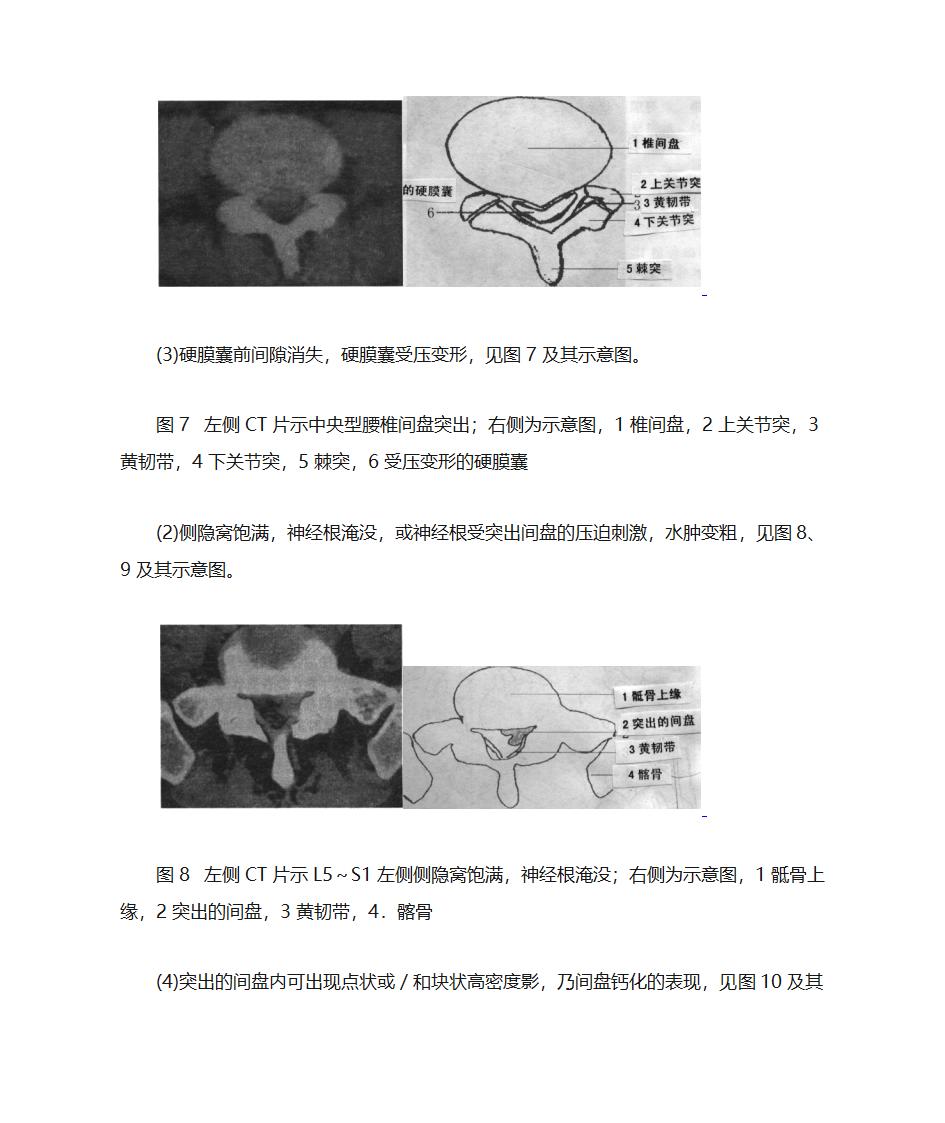 腰间盘突出诊断第7页