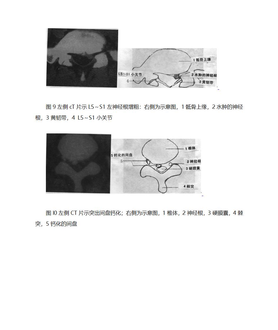 腰间盘突出诊断第9页